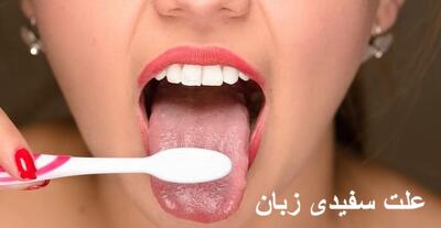 علت سفیدی زبان در نوزاد و بزرگسالان چیست؟ + درمان سفیدی زبان
