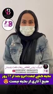 لیفت ابرو بدون جای بخیه