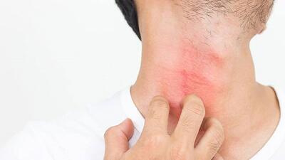 روش های موثر برای درمان خانگی کهیر ؛ دلایل و روش تشخیص انواع کهیر