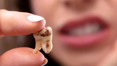 علت اصلی پوسیدگی سریع دندان‌ ها چیست؟