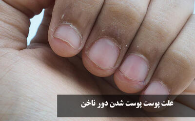 علت پوست پوست شدن دور ناخن | کمبود چه ویتامینی باعث ریش ریش شدن ناخن میشود؟