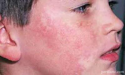 علائم مخملک در کودکان ؛ همه چیز درباه بیماری مخملک در کودکان ( از علائم تا درمان )