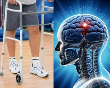دست آورد پزشکی؛ بیمار فلج چینی با ایمپلنت نخاعی دوباره راه رفت - سبک ایده آل