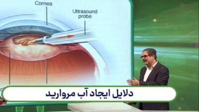 دلایل ایجاد بیماری آب مروارید + فیلم
