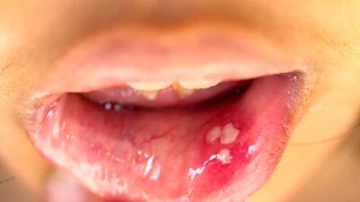 مشاهده HPV دهانی در افراد 13 تا 75 ساله! / فروش واکسن گارداسیل با قیمت نجومی بدون تضمین سلامت / تست های HPV دهانی تا 70 درصد نتیجه منفی کاذب دارد!