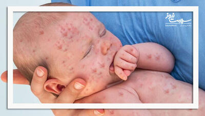 بازگشت سرخک؛ بهای سنگین اعتماد به واکسن‌گریزی و شبه‌علم