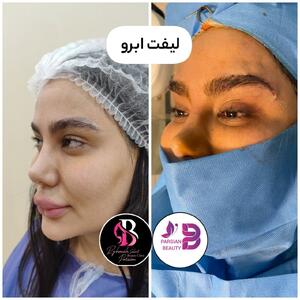 لیفت ابرو بدون عمل جراحی؛ زیبایی طبیعی در کمترین زمان