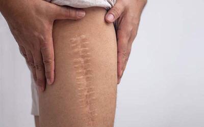 جایگزینی جدید برای بخیه های پزشکی که ۸ برابر موثرتر است + فیلم