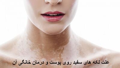 علت لکه های سفید روی پوست کمبود کدام ویتامین در بدن است؟ درمان خانگی
