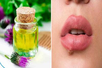 از بین بردن تبخال با روش های خانگی در 24 ساعت / معجزه ای که با این روغن رقم میخوره