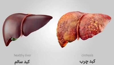 با این سه مورد کبد چرب تان را درمان کنید