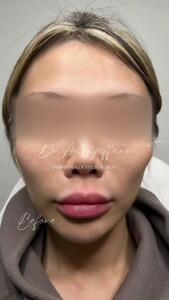 تخلیه ژل سیلیکونی گونه