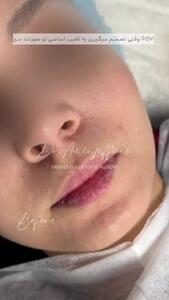 تزریق ژل به لب