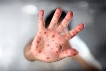 وزارت بهداشت درباره این بیماری هشدار مهمی داد