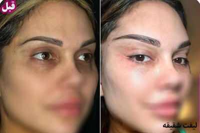آیا انجام لیفت شقیقه برای شما مناسب است؟