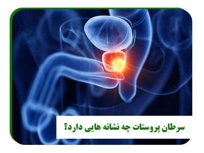 بهترین رژیم غذایی برای کاهش ریسک ابتلا به سرطان پروستات | شفقنا