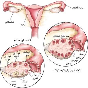 علائم کیست تخمدان چیست ؟ |  انصاف نیوز