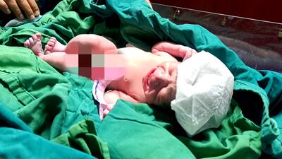 جگرگوشه پیوند کبد گیلان متولد شد