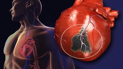 علائم پنهان حملات قلبی (فیلم)