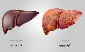 پشت پرده ارتباط مرگبار دیابت و کبد چرب/ دارویی که هر دو را مهار می‌کند!