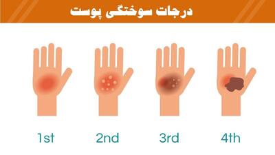 درجات سوختگی؛ از التهاب تا آسیب‌های عمیق + فیلم