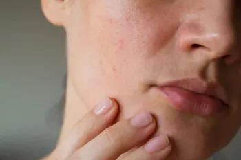 چگونه تغییرات هورمونی بر سلامت پوست اثر می گذارد؟ - سبک ایده آل