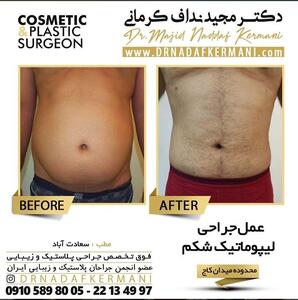 قیمت لیپوماتیک در سال ۱۴۰۴، مزایای آن را می‌دانید؟