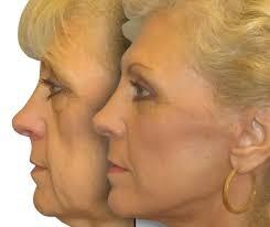 همه آنچه درباره عمل لیفت گونه باید بدانید!