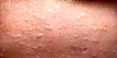 چگونه جوش‌های زیر پوستی را درمان کنیم؟