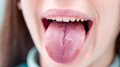 علل اصلی ترک خوردگی و شکاف زبان چیست؟