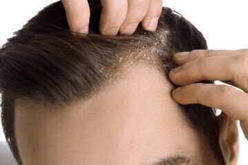 مهم‌ترین علت های شوره سر  چیست؟