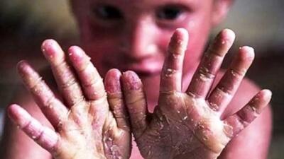 شکایت بیماران پروانه‌ای از بنیاد امور بیماری‌های خاص/ به رغم دریافت بودجه، در ۷ سال گذشته به بیماران خدمات نداده‌اند/ انتقاد از عدم پاسخگویی به تمام مکاتبات