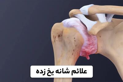 اهمیت بررسی ابتلا به بیماری های زمینه ای در سندروم شانه یخ زده