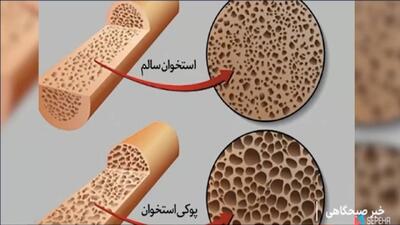 ترمیم استخوان آسیب دیده با فناوری نانو + فیلم