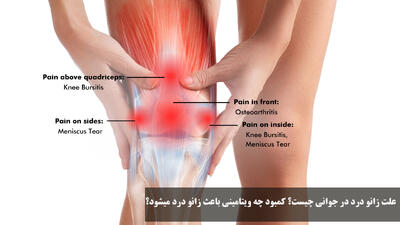 علت زانو درد در جوانی چیست؟ کمبود چه ویتامینی باعث زانو درد میشود؟