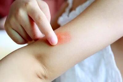 وزارت بهداشت درباره پشه آئدس هشدار داد
