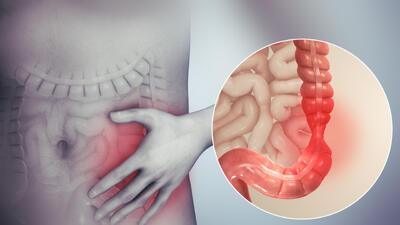 توضیحی کامل درباره سندروم روده تحریک پذیر