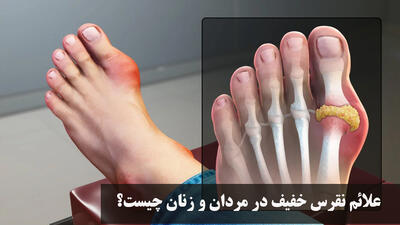 علائم نقرس خفیف در مردان و زنان چیست؟ برای درمان نقرس چه بخوریم؟